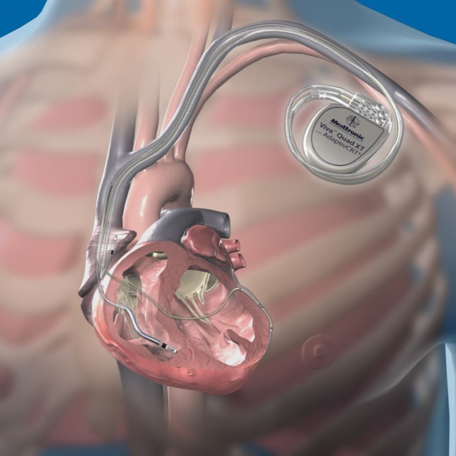 Dual Chamber Pacemaker Kartik Heart Centre Dual Chamber Pacemaker Kartik Heart Centre