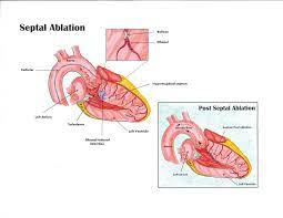 alcohol septal ablation