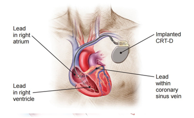 Cardiac Resynchronization Therapy (CRT)