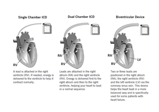 implantable cardioverter-defibrillator